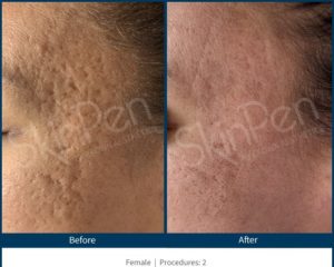 Microneedling Before and After | Kendall Esthetics in Sidney, NE