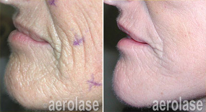 EraElite By Aerolase Before and After | Kendall Esthetics in Sidney, NE
