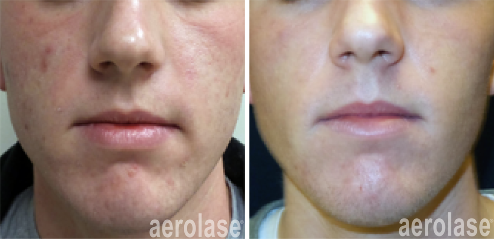 NeoClear by Aerolase Before and After | Kendall Esthetics in Sidney, NE