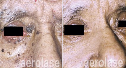 EraElite Laser Treatment Before & After | Kendall Esthetics in Sidney, NE