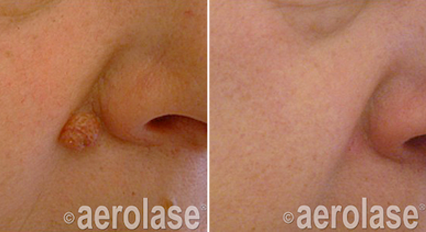EraElite Laser Treatment Before & After Photos | Kendall Esthetics in Sidney, NE