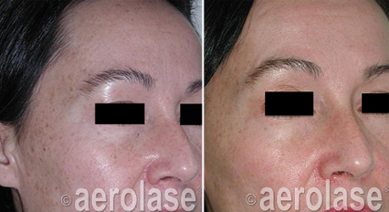 EraElite Laser Treatment Before & After Images | Kendall Esthetics in Sidney, NE