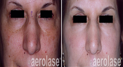 EraElite Laser Treatment Before & After Images | Kendall Esthetics in Sidney, NE
