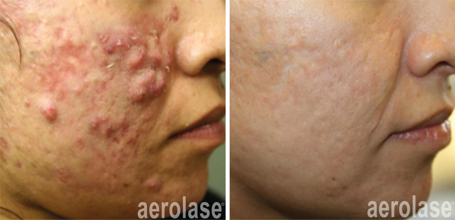 NeoClear treatment Before and After image | Kendall Esthetics in Sidney, NE